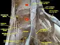 Lumbar and sacral plexus. Deep dissection.Anterior view.