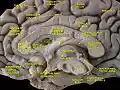 Cerebrum. Medial face. Dissection of corpus callosum etc.