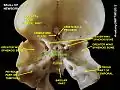 Body of sphenoid bone