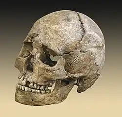 Image 1Skull of the Théviec burial. Female 25 to 35 years died a violent death with numerous skull fractures and bone lesions associated with the impacts of arrow.