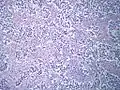 Testicular seminoma, showing a typically prominent lymphocytic infiltrate in the fibrous stroma separating the clusters of tumor cells.