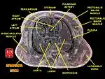 Infraspinatus muscle