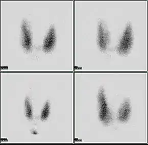 Thyroid scan with iodine-123 for evaluation of hyperthyroidism.