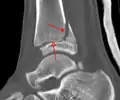 A triplane fracture of the ankle as seen on CT