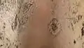 Old lesions, with regrowing hair