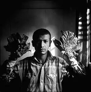 Epidermodysplasia verruciformis patient