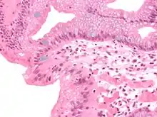 Micrograph of Barrett's esophagus, an example of glandular metaplasia.
