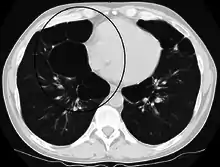 Axial CT image of the lung of a person with end-stage bullous emphysema