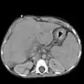 Abdominal CT, showing Morison's pouch as the dark margin surrounding the right kidney (at lower left corner of image).