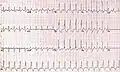 RBBB with associated tachycardia
