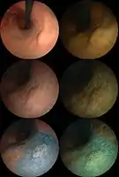 Endoscopic images of an early stage stomach cancer. 0-IIa, tub1. Left column: Normal light. Right column: computed image enhanced (FICE). First row: Normal. Second row: Acetate stained. Third row: Acetate-indigocarmine mixture (AIM) stained.