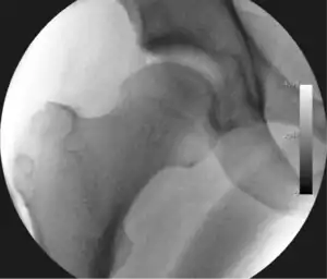 Figure 3. Fluoroscopic picture showing a mild amount of distraction of the hip before insertion of any instruments