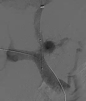 X-ray of a tube being inserted between two black contrast-filled veins