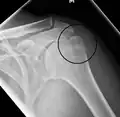 Fracture of the greater tuberosity of the humerus