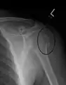 A fracture of the greater tuberosity as seen on AP X ray