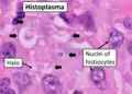 Histopathology of Histoplasma capsulatum, H&E stain, showing organisms surrounded by halos, in a granuloma of epithelioid histiocytes.