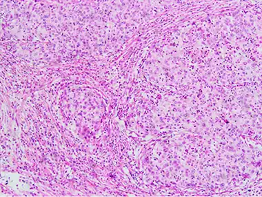 Invasive squamous cell carcinoma of the cervix is characterized by infiltration as irregular anastomosing nests or single cells. This case is poorly differentiated. H&E stain.