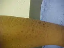 Thick, fish-like scales on an adult lower leg