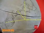 Wormian bones at lambdoid suture