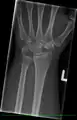 Left hand x-ray post proximal row carpectomy