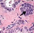 Acinar adenocarcinoma with multiple nucleoli.
