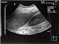 Ultrasonographic view of the abdomen demonstrating fluid within Morison's pouch.
