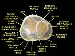 Muscles of upper limb.Cross section.