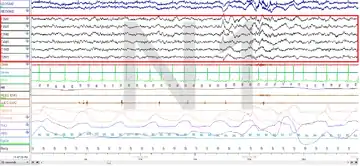 Stage N1 Sleep. EEG highlighted by red box.