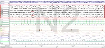 Stage N2 Sleep. EEG highlighted by red box. Sleep spindles highlighted by red line.
