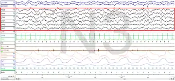Stage 3 Sleep. EEG highlighted by red box.