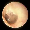 This is a normal left eardrum.