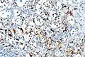 S100 immunostain highlighting the sustentacular cells in a paraganglioma