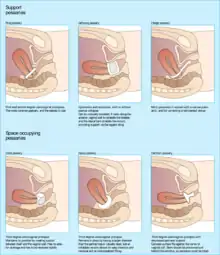 Images of pessaries of different shapes inserted into the vaginal canal