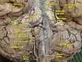 Cerebrum.Inferior view.Deep dissection