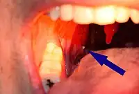 A tonsillolith protrudes from the tonsil