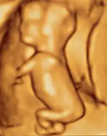 3D ultrasound of 3-inch (76 mm) fetus (about 14 weeks gestational age)