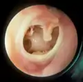 A subtotal perforation of the right tympanic membrane resulting from a previous severe otitis media